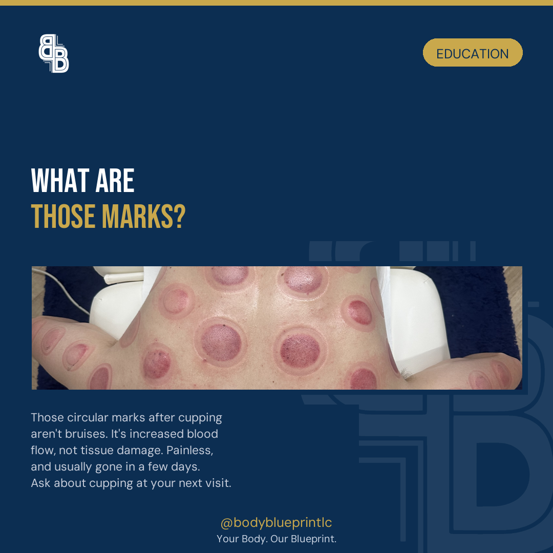 Why cupping marks aren't bruises